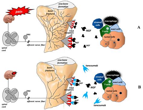 Ijms Free Full Text Bone Pain In Cancer Patients Mechanisms And