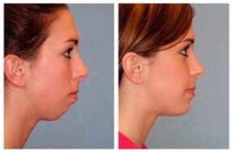 wow these chin implants really helped these people with 