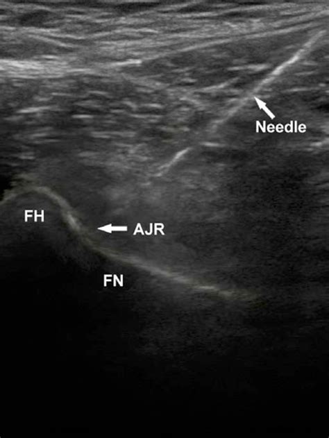 Figure 2 From The Efficacy Of Ultrasound Guided Intra Articular Pulsed