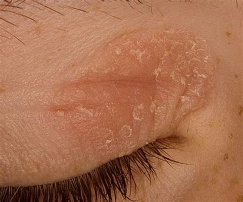 Eczema On Eyelid Medical Point
