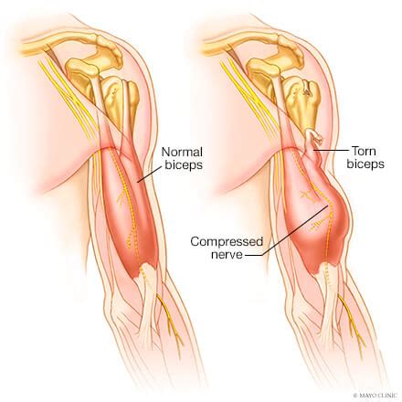 Biceps Tendonitis Overview Mayo Clinic Orthopedics Sports Medicine