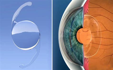 Laser Lens Exchange Vs Laser Cataract Surgery Centre For Sight