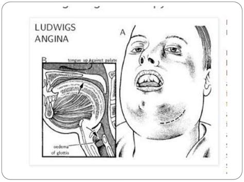 Ludwigs Angina