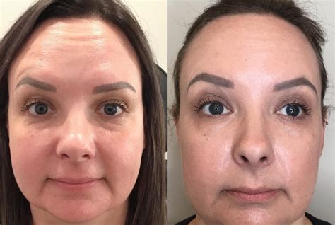 Botox And Dysport Before And After Pictures Case 45 Sacramento Ca