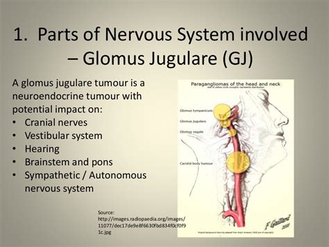 Personal Journey With A Glomus Jugulare Tumour2