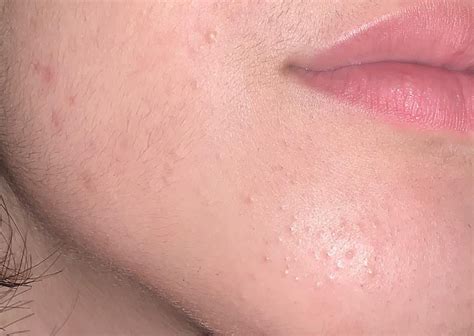 Acne Closed Comedones All Over Face Consistent Breakouts In The Same