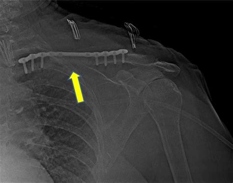 Cureus Pathological Clavicle Fracture Initial Presentation Of