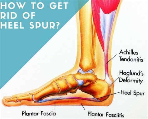 How To Get Rid Of Heel Spur Home Remedies For Treatment Of Heel Spur