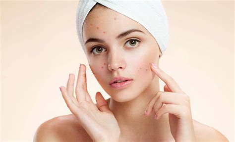 Causes Of Pregnancy Acne And Home Remedies To Treat It Imagup