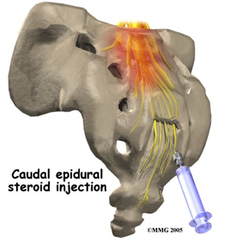 • the epidural space is the small space lying between the spinal meninges (layers surrounding the spinal cord) and the sides of the vertebral canal. Epidural Steroid Injection | Novocur