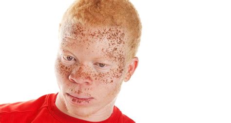 Cancer Proposed As Spur For Evolution Of Dark Skinned Ancestors People With Red Hair Light