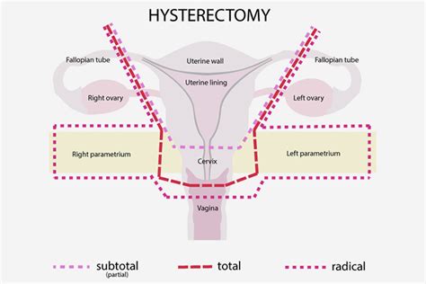 Background occult invasive cervical cancer (oicc) is sometimes incidentally found in surgical specimens after a simple hysterectomy (sh). Can You Get Pregnant After Hysterectomy?