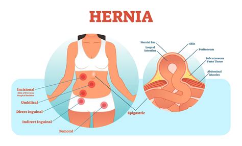 Check spelling or type a new query. How Anyone Can Get a Hernia (Including Women) | Health ...