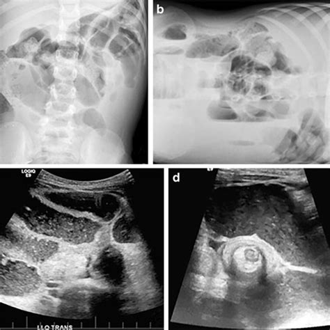 Use Of Ultrasound In Diagnosing Postoperative Small Bowel