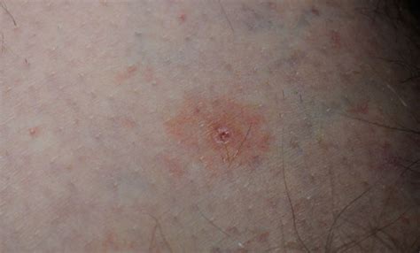 Skin Rash From Tick Bite
