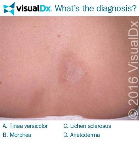 Atrophic Lesions Unnerve Female Patient Lets Diagnose Visualdx