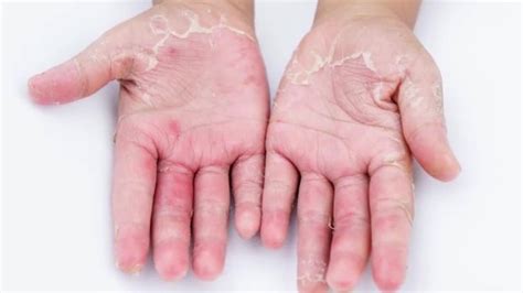 Remedies To Help Cure The Dryness Caused By Hand Washing Sanitizing
