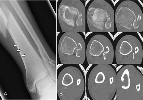 A The Spiral Tibia Fracture Line Was Contiguous With The Pmf Arrows