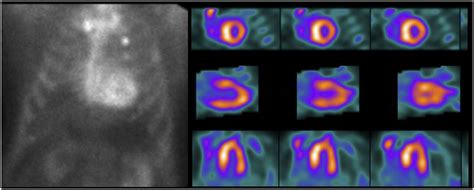 Molecular Imaging Of Cardiac Amyloidosis Journal Of Nuclear Medicine