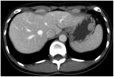 Abdominal Computed Tomography Ct Findings The Ct Scan Shows A 18 Cm