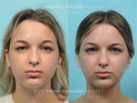 Buccal Fat Removal Before And After Photos Atlanta Ga