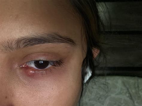 Red Bump On On Lower Eyelid Im Not Sure What It Is Popping