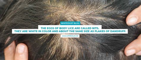 5 Things You Didnt Know About Body Lice 2020 Whitedust