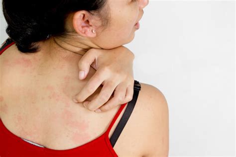 Healthiculture Skin Rash And Itch In Fibromyalgia