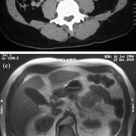 A Abdominal Ct Scan Of 40 Year Old Male With No Rectus Separation B