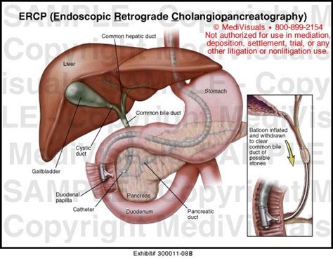 Ercp Endoscopic Retrograde Cholangiopancreatography Medical Exhibit