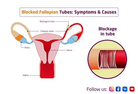 Blocked Fallopian Tubes Symptoms Causes And Diagnosis