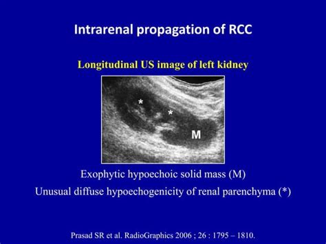 Ultrasound Of The Urinary Tract Renal Tumors