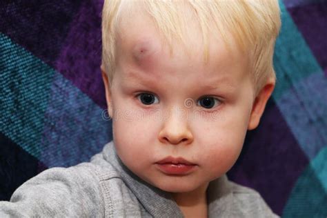 A Big Bruise On The Forehead Of A Little Boy Stock Image Image Of