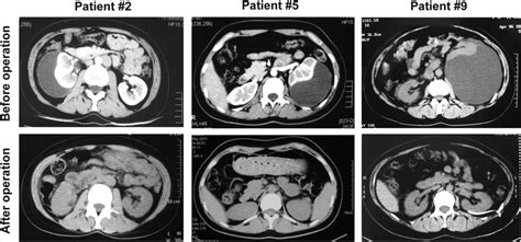 Ct Scan Images Before And After Retroperitoneal Laparoscopic Renal