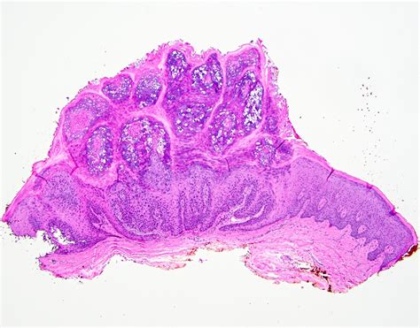 Pathology Outlines Verruca Vulgaris