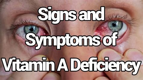 Vitamin A Deficiency 8 Signs And Symptoms Of Vitamin A Deficiency