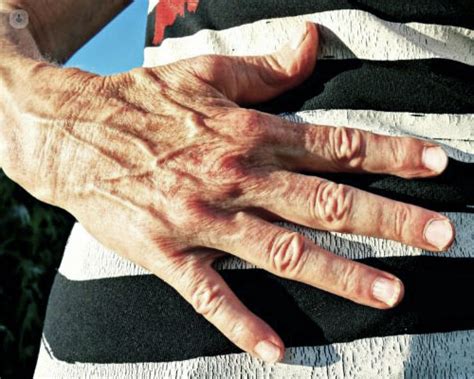 The Truth About Bulging Hand Veins