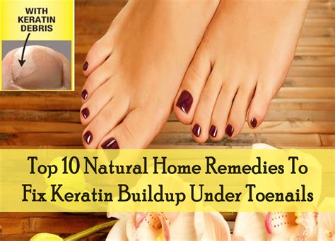 47 Best Of 10 Home Remedies For Toe Fungus Home Decor Ideas