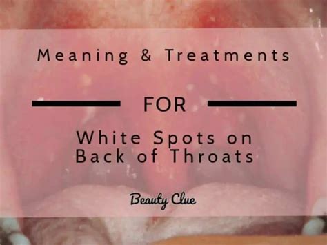 White Spots On The Throat With Pictures