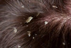 Tents, blankets, rugs, clothing, and rope. Can bed bugs get in your hair? Yep, now find out how to ...