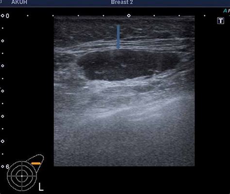 Cureus Preoperative Ultrasound Guided Core Biopsy Of Axillary Nodes
