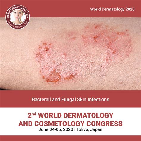 Bacterial And Fungal Skin Infections World Dermatology 2020 Global