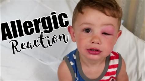 Severe Child Allergic Reaction🚨emergency Room Vlog Youtube