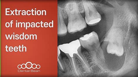 Front Teeth Hurt After Wisdom Tooth Extraction