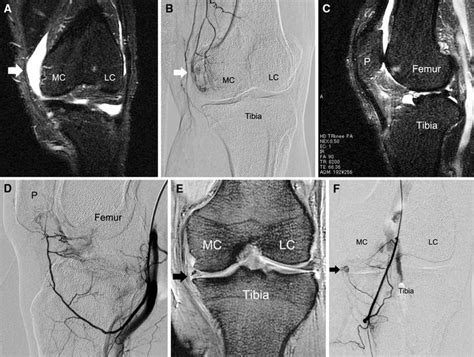 Transcatheter Arterial Embolization As A Treatment For Medial Knee Pain