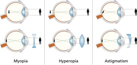 Nearsighted Vs Farsighted Which Is More Common Charolette Malley