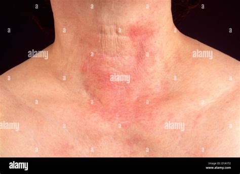 Contact Dermatitis Stock Photo Alamy