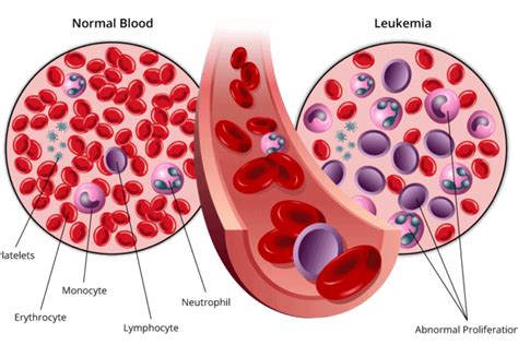About Acute Lymphocytic Leukemia All Healthinfi
