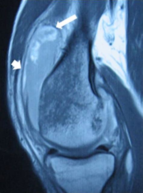 Post Traumatic Haemorrhagic Synovitis Of Knee Mimicking Pigmented