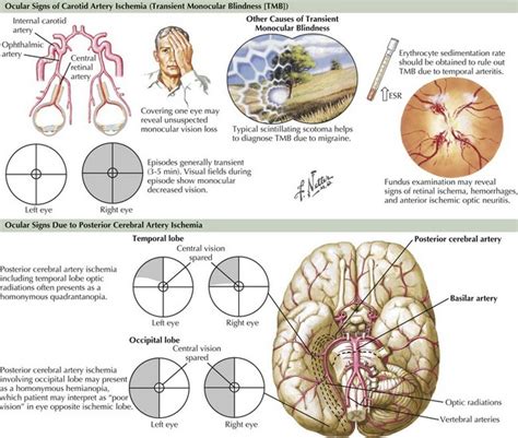 Ischemic Stroke Clinical Gate